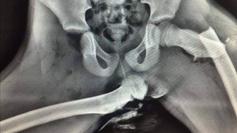 Radiografia a raggi X di chi ha poggiato i piedi in alto mentre era passeggero in auto
